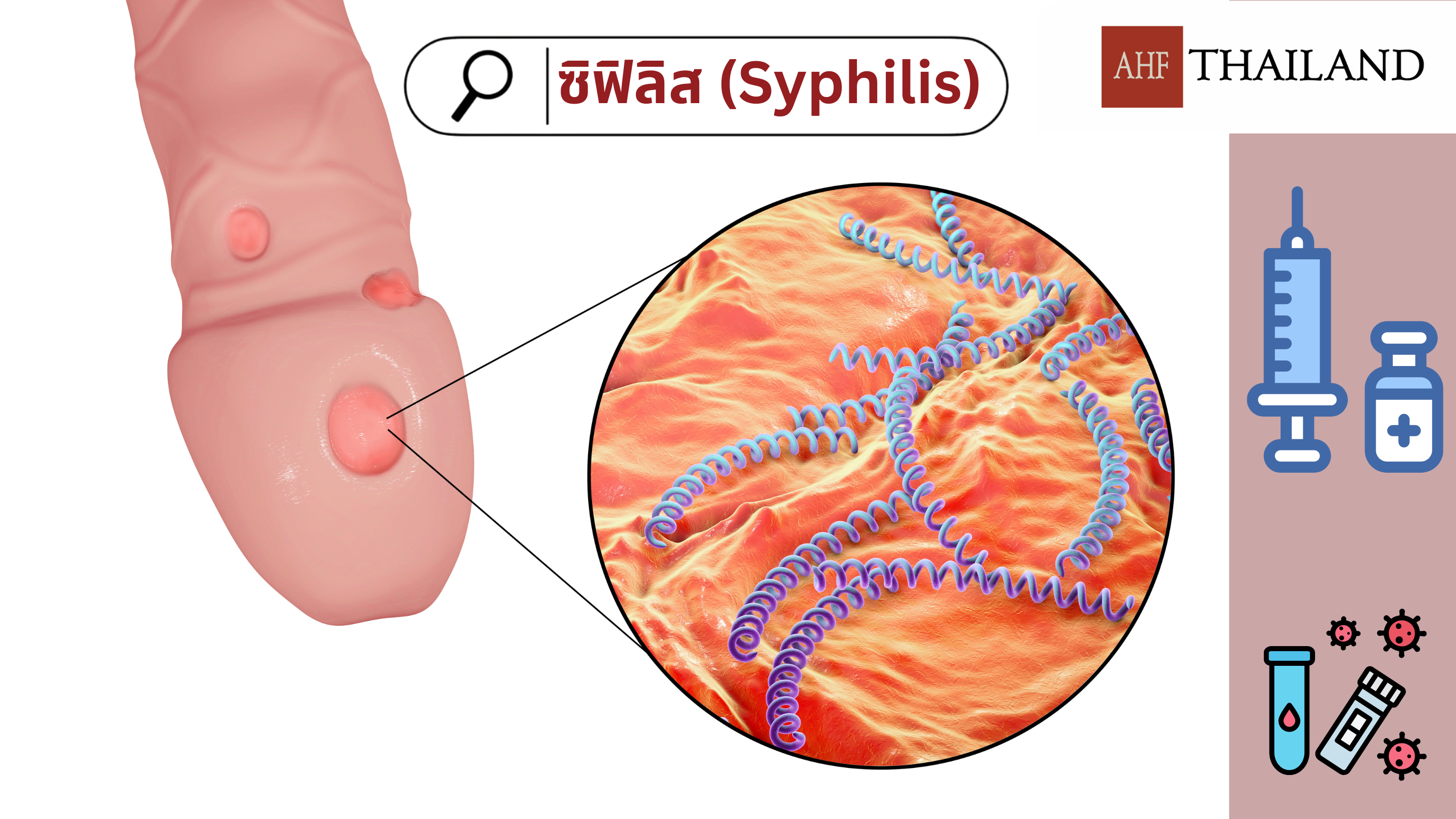ซิฟิลิส..ป้องกันได้ สวมถุงยางทุกครั้้งที่มีเพศสัมพันธ์